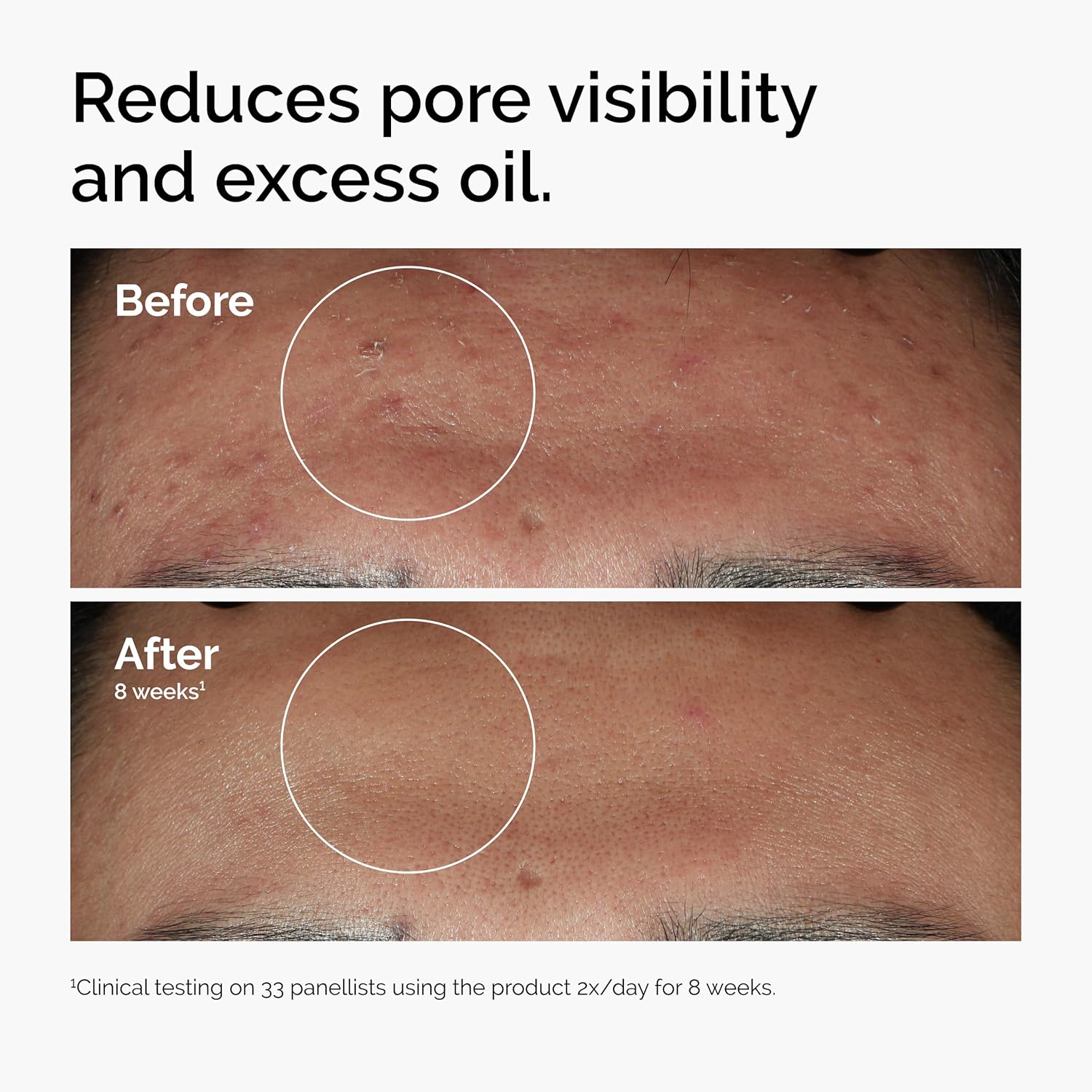 The Ordinary Niacinamide 10% + Zinc 1% Smoothing Serum | Blemish-Prone Skin | New